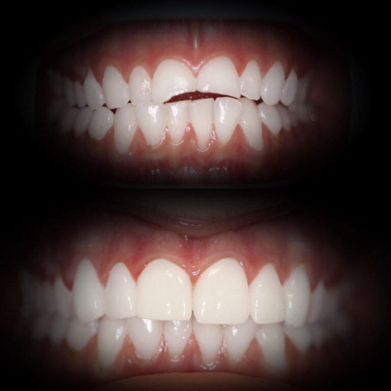 advanced dental care newport beach