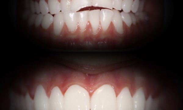 advanced dental care newport beach